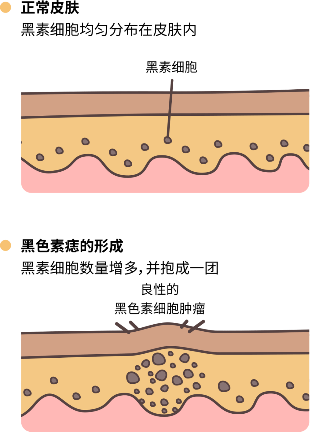 黑痣长在哪里好 黑痣越长越大什么原因